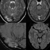 Ha l’emicrania da 7 anni: le trovano una cisti piena di vermi nel cervello Ha l’emicrania da 7 anni: le trovano una cisti piena di vermi nel cervello