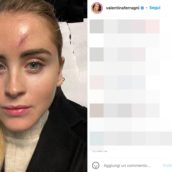 Valentina Ferragni racconta su Instagram l’intervento chirurgico: “Sembrava solo un brufolo”